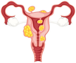 PCOS क्या है? महिलाओं के लिए असरदार 5 समाधान